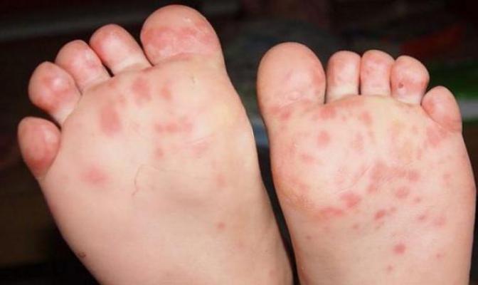 Symptoms, treatment, photos of the coxsackie virus in children and adults
